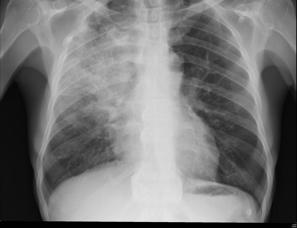 Chest X-Ray analysis