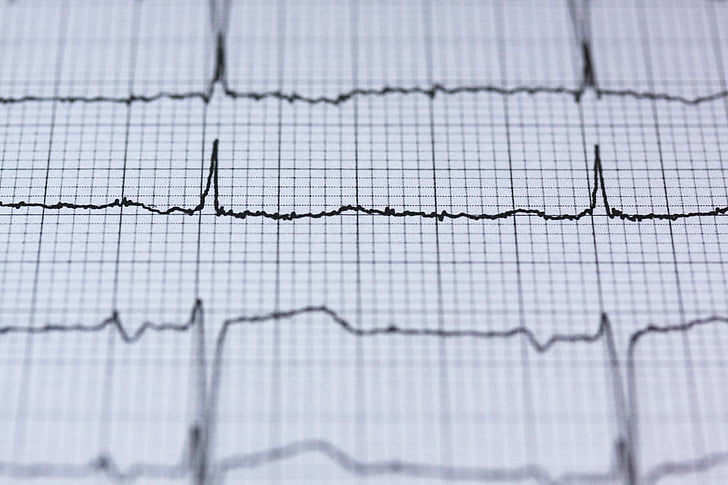 ECG signal analysis